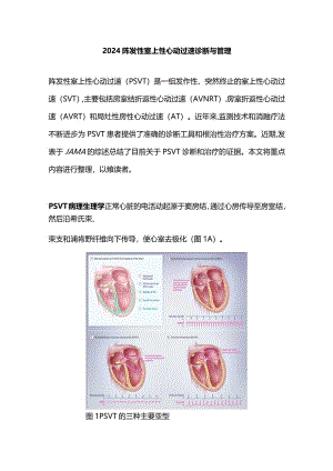 2024阵发性室上性心动过速诊断与管理.docx