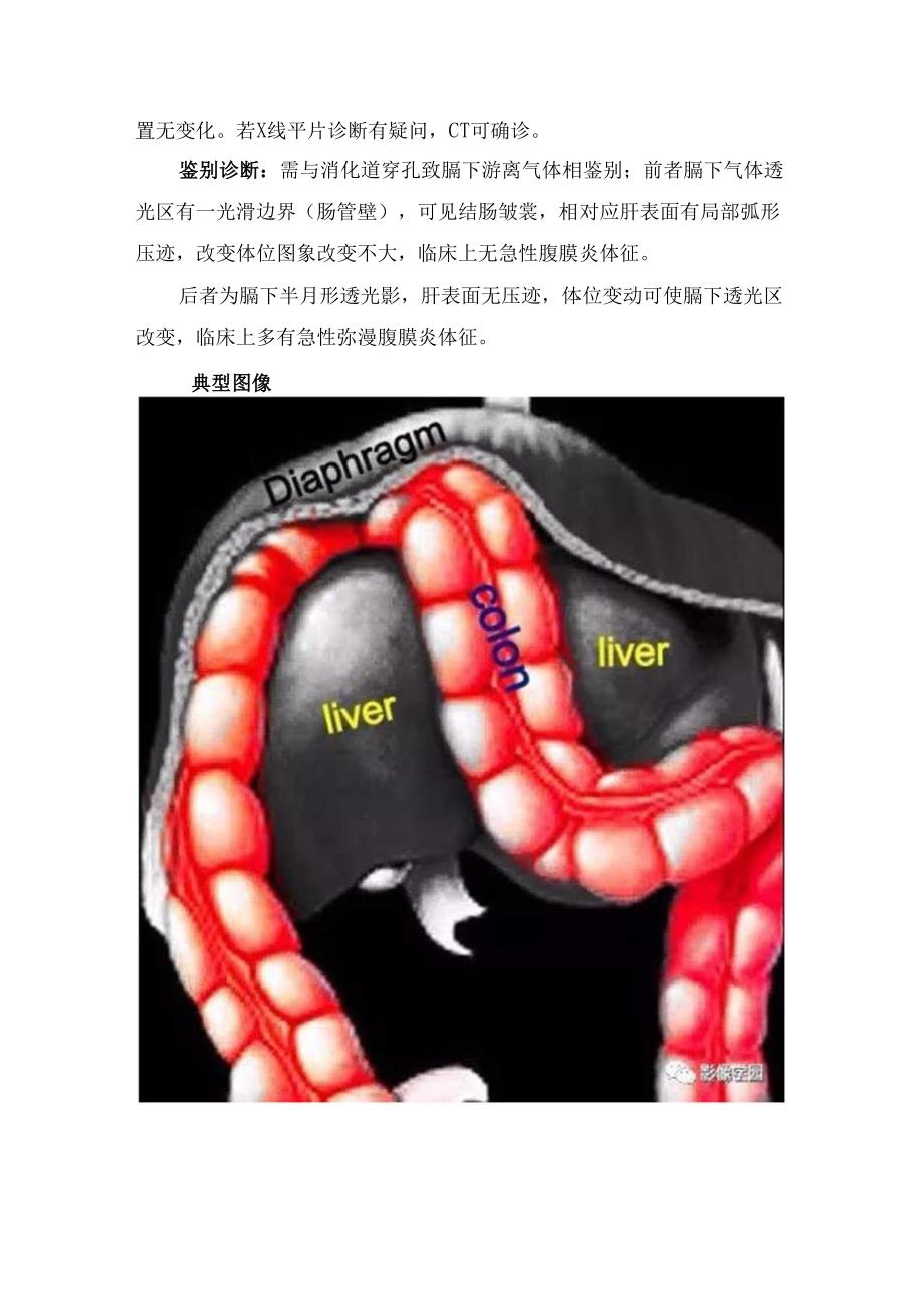 临床Chilaiditi征病理、临床表现、影像表现、鉴别诊断及典型图像.docx_第2页