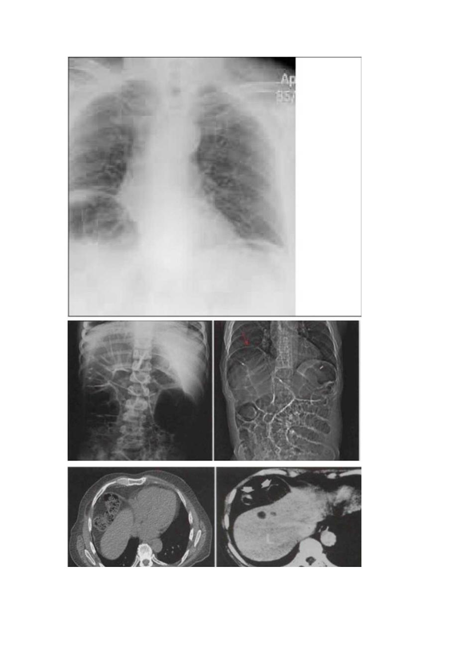 临床Chilaiditi征病理、临床表现、影像表现、鉴别诊断及典型图像.docx_第3页