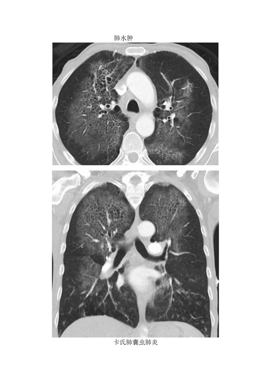 临床蝙蝠翼样肺部影临床表现、常见疾病及鉴别诊断.docx_第2页