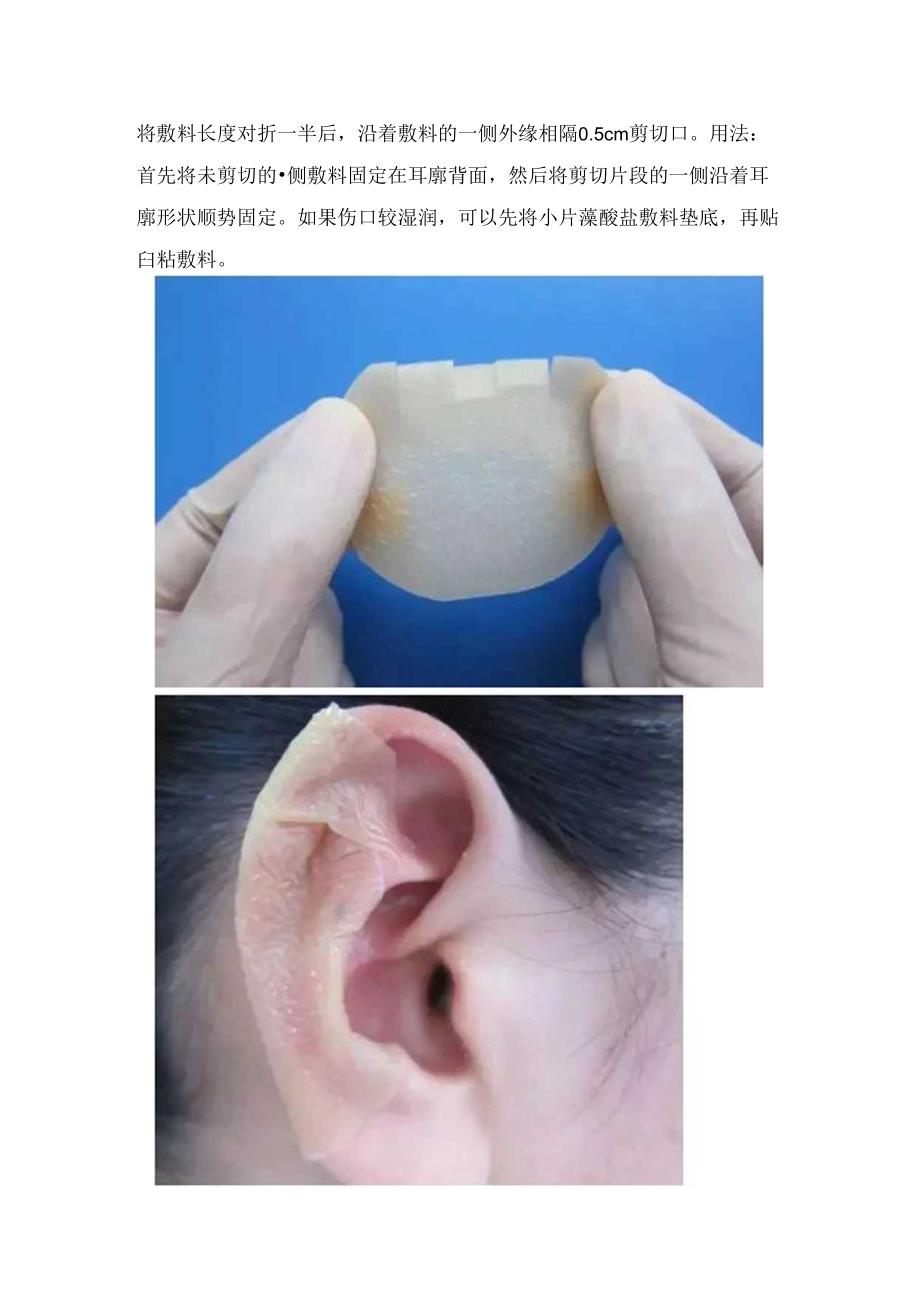 临床护理自粘型新型伤口敷料固定、特殊部位敷料粘贴技巧及免缝胶带粘贴技巧.docx_第2页