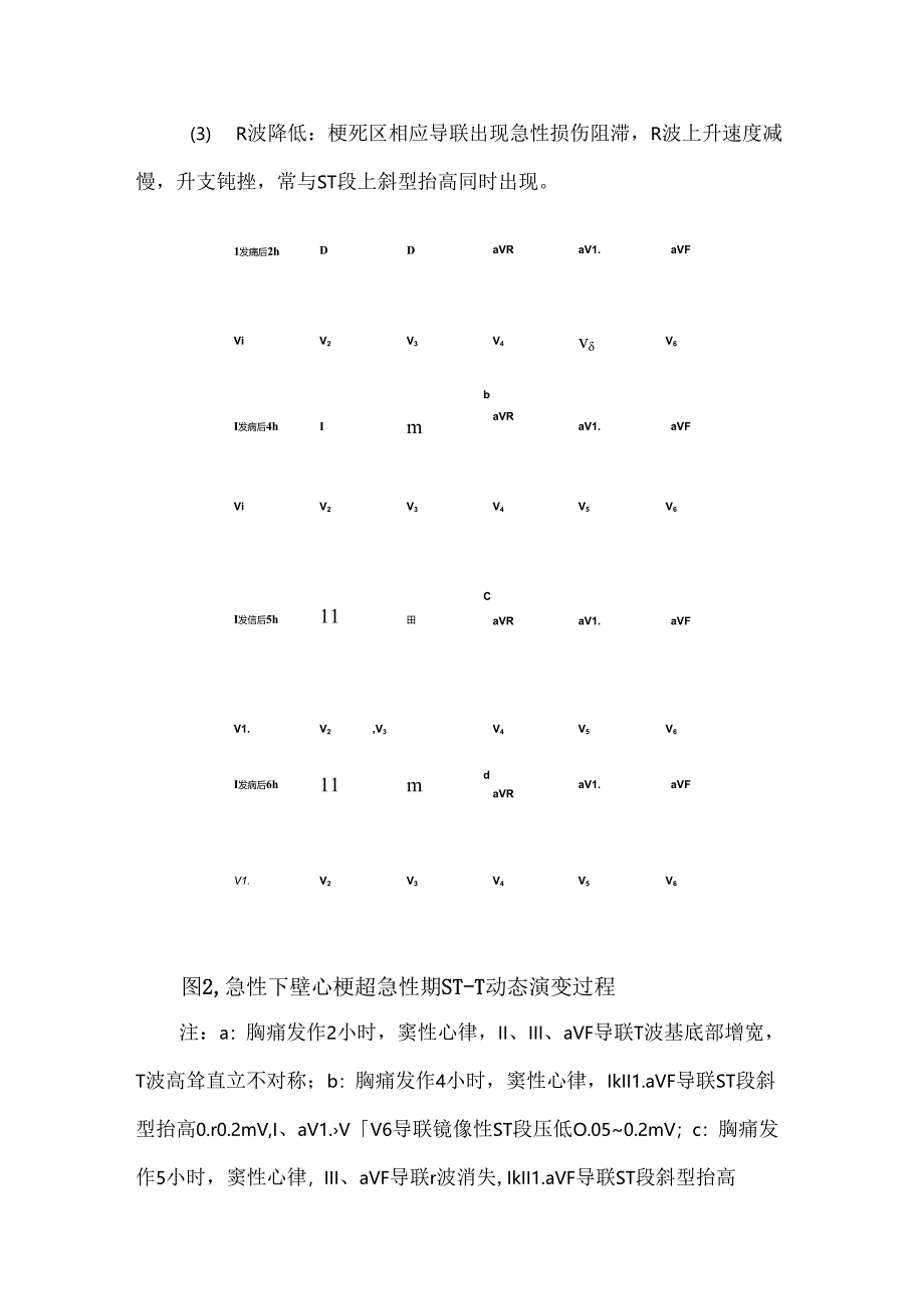 STEMI诊断与鉴别诊断要点.docx_第3页