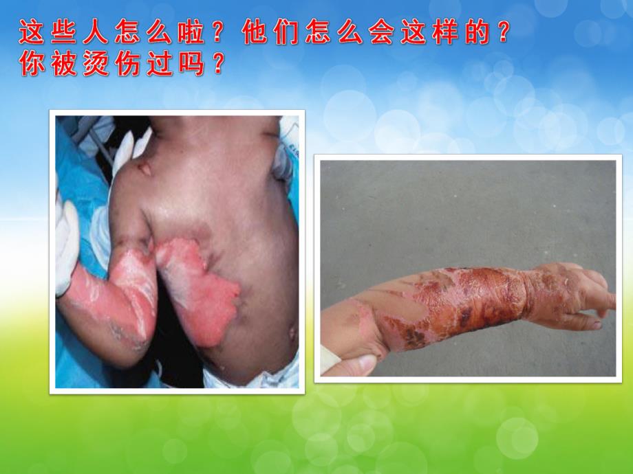 中班健康《小心烫伤》PPT课件教案PPT课件.ppt_第3页