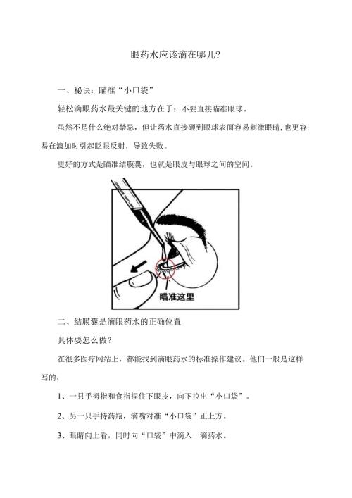 眼药水应该滴在哪儿？（2024年）.docx