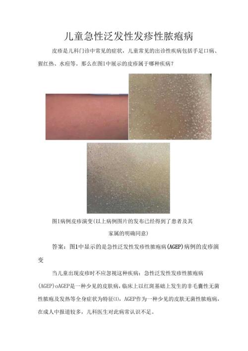 儿童急性泛发性发疹性脓疱病.docx